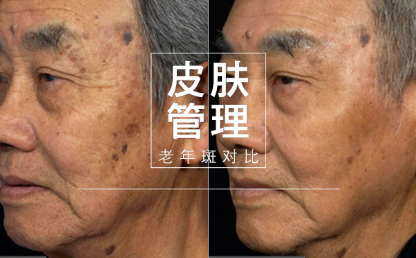老年斑-贵阳皮肤管理中心