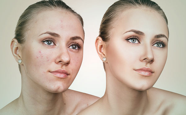 贵阳皮肤管理中心祛痘案例